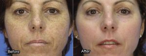 Before and After Fillers